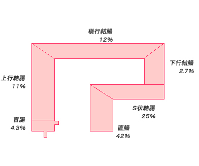 大腸癌発見部位